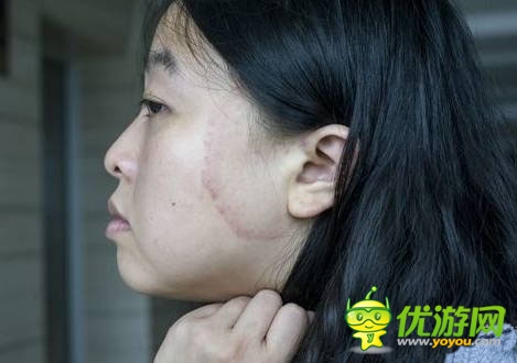 皮膚太嫩？女子用iPhone5S打電話險致毀容